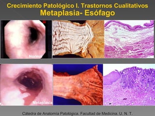 Crecimiento Patológico I. Trastornos Cualitativos Metaplasia- Esófago Cátedra de Anatomía Patológica. Facultad de Medicina. U. N. T. Normal Metaplasia 