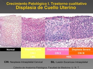 Crecimiento Patológico I. Trastorno cualitativo Displasia de Cuello Uterino   Cátedra de Anatomía Patológica. Facultad de Medicina. U. N. T. HSIL Normal CIN I CIN II CIN III Displasia Leve Displasia Moderada Displasia Severa LSIL CIN:  Neoplasia Intraepitelial Cervical SIL:  Lesión Escamosa Intraepitelial 