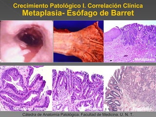 Crecimiento Patológico I. Correlación Clínica Metaplasia- Esófago de Barret Cátedra de Anatomía Patológica. Facultad de Medicina. U. N. T. Metaplasia Intestinal Displasia Neoplasia Metaplasia 