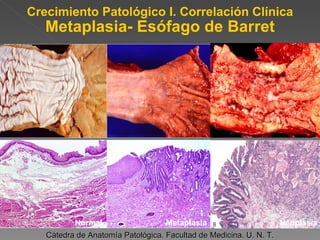 Crecimiento Patológico I. Correlación Clínica Metaplasia- Esófago de Barret Cátedra de Anatomía Patológica. Facultad de Medicina. U. N. T. Normal Metaplasia Neoplasia 