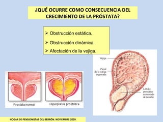 HOGAR DE PENSIONISTAS DEL BERRÓN. NOVIEMBRE 2009 ¿QUÉ OCURRE COMO CONSECUENCIA DEL CRECIMIENTO DE LA PRÓSTATA? Obstrucción estática. Obstrucción dinámica. Afectación de la vejiga. 