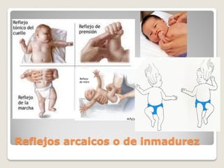 Reflejos arcaicos o de inmadurez
 