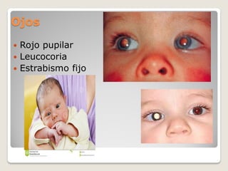Ojos
 Rojo pupilar
 Leucocoria
 Estrabismo fijo
 