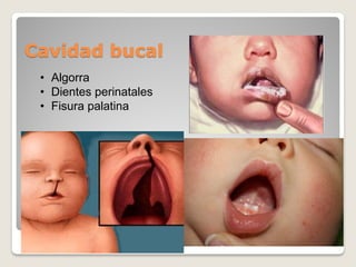 Cavidad bucal
• Algorra
• Dientes perinatales
• Fisura palatina
 