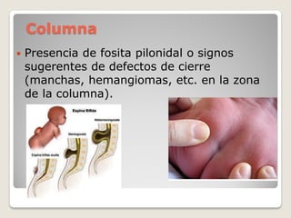 Columna
 Presencia de fosita pilonidal o signos
sugerentes de defectos de cierre
(manchas, hemangiomas, etc. en la zona
de la columna).
 