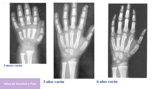 Atlas de Greulich y Pyle
 