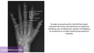 Se asigna una puntuación a las distintas etapas
evolutivas del hueso y de esta forma un fenómeno
cualitativo, que se expresa por cambios morfológicos,
se transforma en un dato numérico que puede ser
analizado
Tanner-Whitehouse (TW2)
 