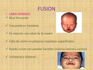 FUSION
• LABIO HENDIDO
 Muy frecuente
 Frecuente en hombres
 En relación con edad de la madre
 Falta de unión en procesos maxilares superficiales
 Puede cursar con paladar hendido (insicivo lateral y canino)
 Unilateral o bilateral
 