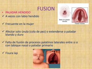 FUSION
• PALADAR HENDIDO
 A veces con labio hendido
 Frecuente en la mujer
 Afectar solo úvula (cola de pez) o extenderse a paladar
blando y duro
 Falta de fusión de procesos palatinos laterales entre si o
con tabique nasal o paladar primario
 Fisura lap
 