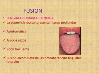 FUSION
• LENGUA FISURADA O HENDIDA
 La superficie dorsal presenta fisuras profundas
 Asintomática
 Ambos sexos
 Poco frecuente
 Fusión incompleta de las protuberancias linguales
laterales
 