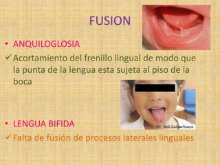 FUSION
• ANQUILOGLOSIA
Acortamiento del frenillo lingual de modo que
la punta de la lengua esta sujeta al piso de la
boca
• LENGUA BIFIDA
Falta de fusión de procesos laterales linguales
 