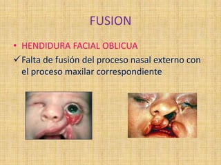FUSION
• HENDIDURA FACIAL OBLICUA
Falta de fusión del proceso nasal externo con
el proceso maxilar correspondiente
 