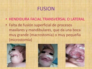 FUSION
• HENDIDURA FACIAL TRANSVERSAL O LATERAL
• Falta de fusión superficial de procesos
maxilares y mandibulares, que da una boca
muy grande (macrostomia) o muy pequeña
(microstomia)
 