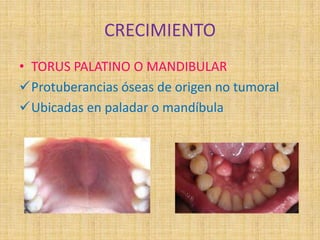CRECIMIENTO
• TORUS PALATINO O MANDIBULAR
Protuberancias óseas de origen no tumoral
Ubicadas en paladar o mandíbula
 