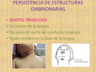 PERSISTENCIA DE ESTRUCTURAS
EMBRIONARIAS
• QUISTES TIROGLOSOS
En la base de la lengua
Por persistir parte del conducto tirogloso
Tejido tiroideo en la base de la lengua
 