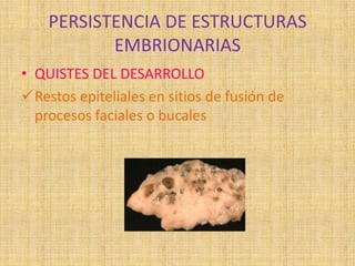 PERSISTENCIA DE ESTRUCTURAS
EMBRIONARIAS
• QUISTES DEL DESARROLLO
Restos epiteliales en sitios de fusión de
procesos faciales o bucales
 