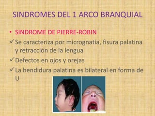 SINDROMES DEL 1 ARCO BRANQUIAL
• SINDROME DE PIERRE-ROBIN
Se caracteriza por micrognatia, fisura palatina
y retracción de la lengua
Defectos en ojos y orejas
La hendidura palatina es bilateral en forma de
U
 