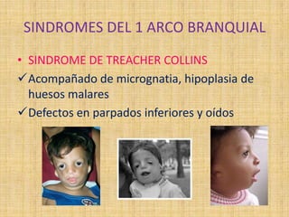 SINDROMES DEL 1 ARCO BRANQUIAL
• SINDROME DE TREACHER COLLINS
Acompañado de micrognatia, hipoplasia de
huesos malares
Defectos en parpados inferiores y oídos
 