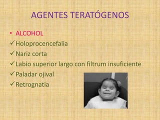 AGENTES TERATÓGENOS
• ALCOHOL
Holoprocencefalia
Nariz corta
Labio superior largo con filtrum insuficiente
Paladar ojival
Retrognatia
 