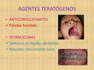 AGENTES TERATÓGENOS
• ANTICONVULSIVANTES
Paladar hendido
• TETRACICLINAS
Defectos en tejidos dentarios
Retardan crecimiento óseo
 