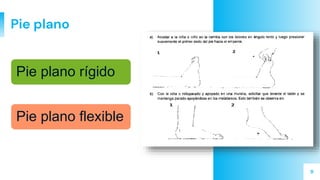 9
Pie plano
Pie plano rígido
Pie plano flexible
 
