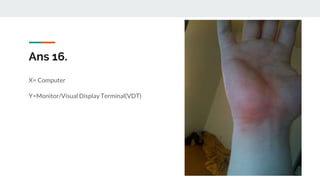 Ans 16.
X= Computer
Y=Monitor/Visual Display Terminal(VDT)
 