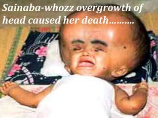 Sainaba-whozz overgrowth of
head caused her death……….
51
 