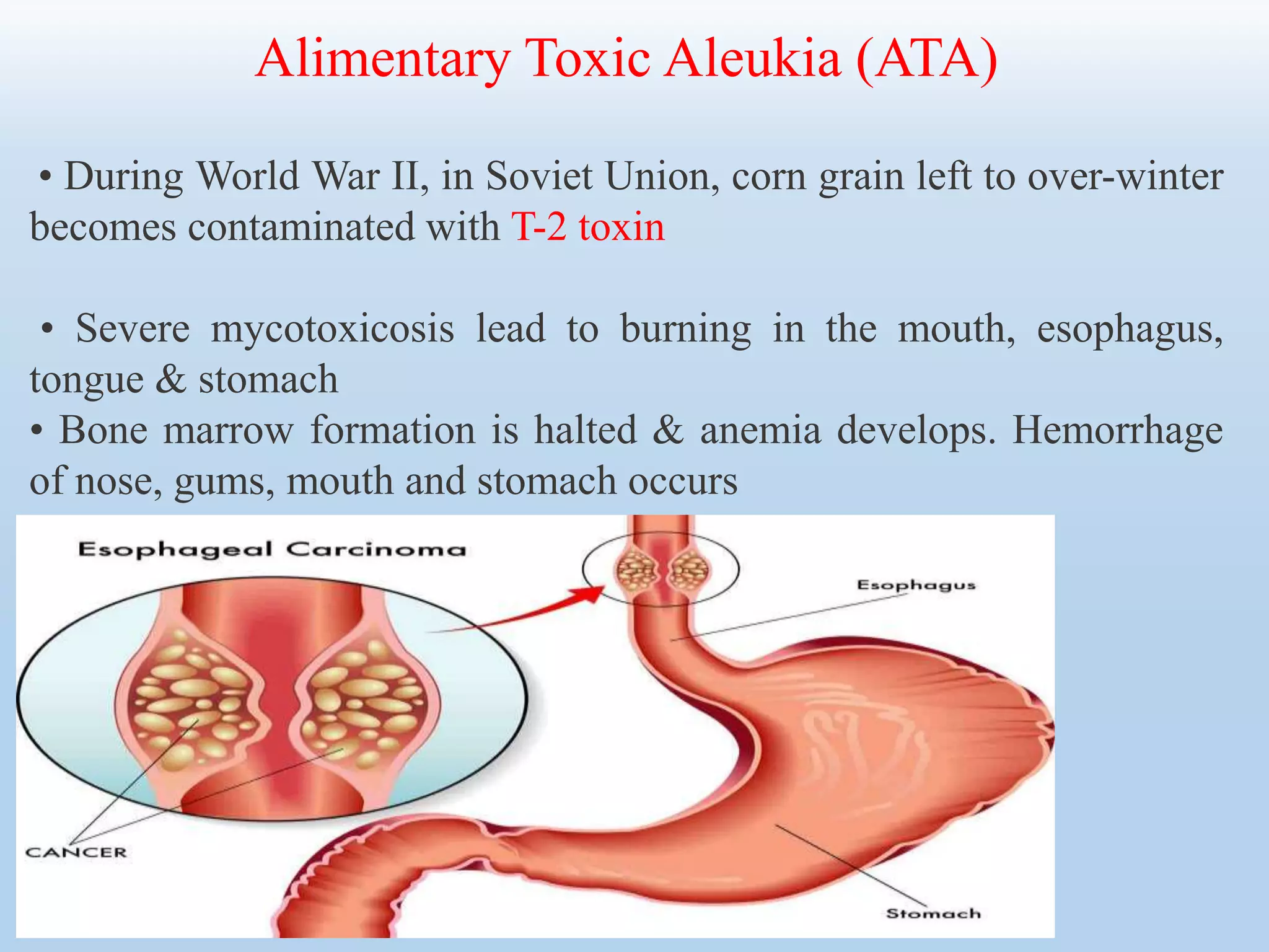 Alimentary Toxic Aleukia (ATA)
• During World War II, in Soviet Union, corn grain left to over-winter
becomes contaminated with T-2 toxin
• Severe mycotoxicosis lead to burning in the mouth, esophagus,
tongue & stomach
• Bone marrow formation is halted & anemia develops. Hemorrhage
of nose, gums, mouth and stomach occurs
 
