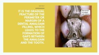 IT IS THE GRADUAL
FRACTURE OF THE
PERIMETER OR
MARGIN OF A
DENTAL AMALGAM
FILLING, WHICH
LEADS TO THE
FORMATION OF
GAPS BETWEEN
THE AMALGAM
AND THE TOOTH.
D E N T M A T
 