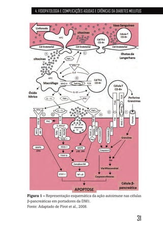 31
4. FISIOPATOLOGIA E COMPLICAÇÕES AGUDAS E CRÔNICAS DA DIABETES MELLITUS
Figura 1 – Representação esquemática da ação autoimune nas células
β-pancreáticas em portadores da DM1.
Fonte: Adaptado de Pirot et al., 2008.
 