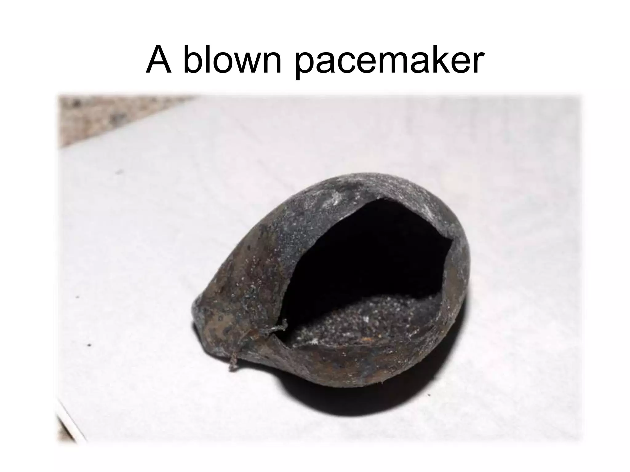 A blown pacemaker
 