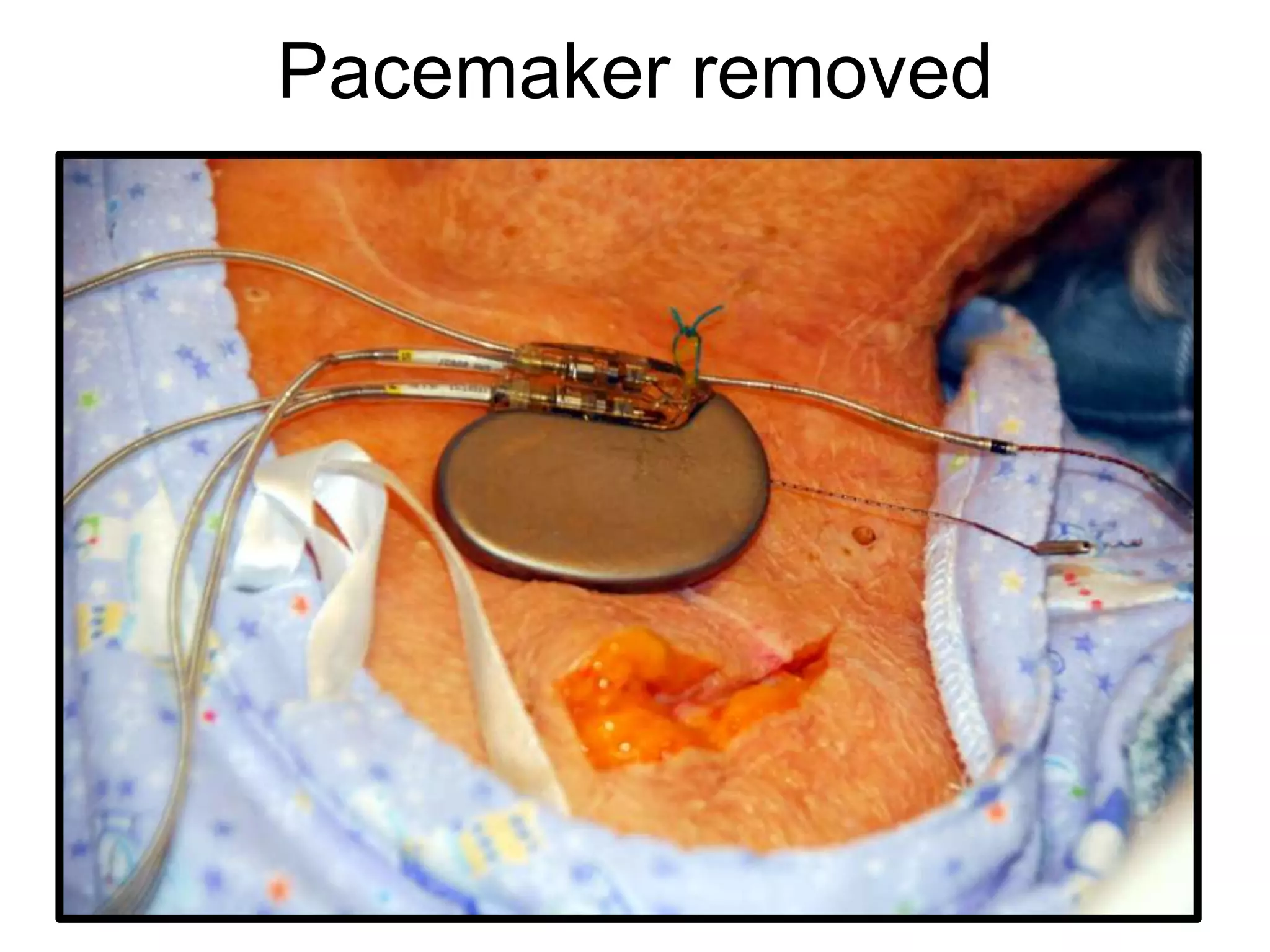 Pacemaker removed
 