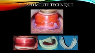 CD clinical tricks (ADEC one day CD)