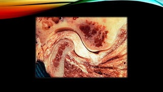 CD clinical tricks (ADEC one day CD)