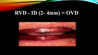 CD clinical tricks (ADEC one day CD)