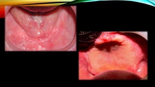 CD clinical tricks (ADEC one day CD)