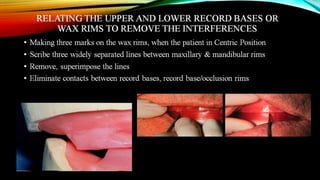 CD clinical tricks (ADEC one day CD)