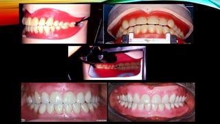 CD clinical tricks (ADEC one day CD)