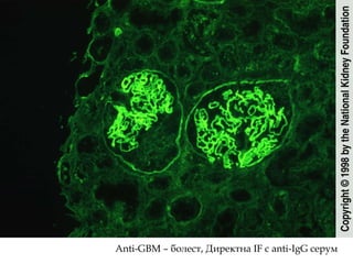 Anti-GBM –  болест, Директна  IF  с  anti-IgG  серум 