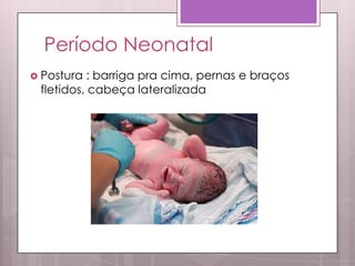 Período Neonatal
 Postura : barriga pra cima, pernas e braços
fletidos, cabeça lateralizada
 