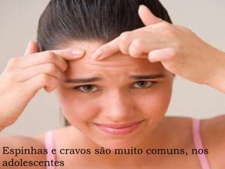 Espinhas e cravos são muito comuns, nos adolescentes  