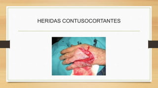 HERIDAS PREDOMINANTEMENTE EXTENDIDAS EN
PROFUNDIDAD
• Heridas punzocortantes:
 