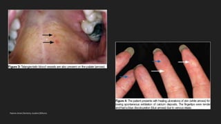 Crest syndrome | PPTX