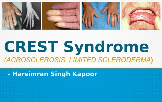 CREST Syndrome | PDF