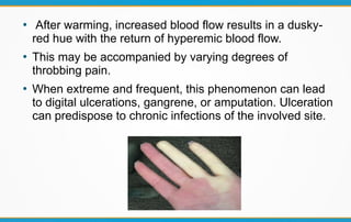 ●
After warming, increased blood flow results in a dusky-
red hue with the return of hyperemic blood flow.
●
This may be accompanied by varying degrees of
throbbing pain.
●
When extreme and frequent, this phenomenon can lead
to digital ulcerations, gangrene, or amputation. Ulceration
can predispose to chronic infections of the involved site.
 
