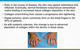 CREST Syndrome | PDF