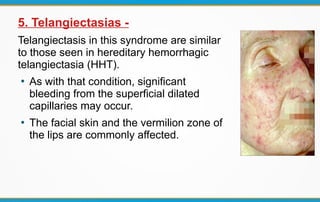 5. Telangiectasias -
Telangiectasis in this syndrome are similar
to those seen in hereditary hemorrhagic
telangiectasia (HHT).
●
As with that condition, significant
bleeding from the superficial dilated
capillaries may occur.
●
The facial skin and the vermilion zone of
the lips are commonly affected.
 