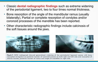 CREST Syndrome | PDF