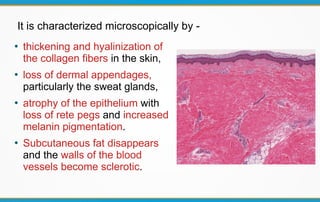 ●
thickening and hyalinization of
the collagen fibers in the skin,
●
loss of dermal appendages,
particularly the sweat glands,
●
atrophy of the epithelium with
loss of rete pegs and increased
melanin pigmentation.
●
Subcutaneous fat disappears
and the walls of the blood
vessels become sclerotic.
It is characterized microscopically by -
 