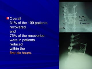 OOvveerraallll 
3311%% ooff tthhee 110000 ppaattiieennttss 
rreeccoovveerreedd 
aanndd 
7755%% ooff tthhee rreeccoovveerriieess 
wweerree iinn ppaattiieennttss 
rreedduucceedd 
wwiitthhiinn tthhee 
ffiirrsstt ssiixx hhoouurrss.. 
 